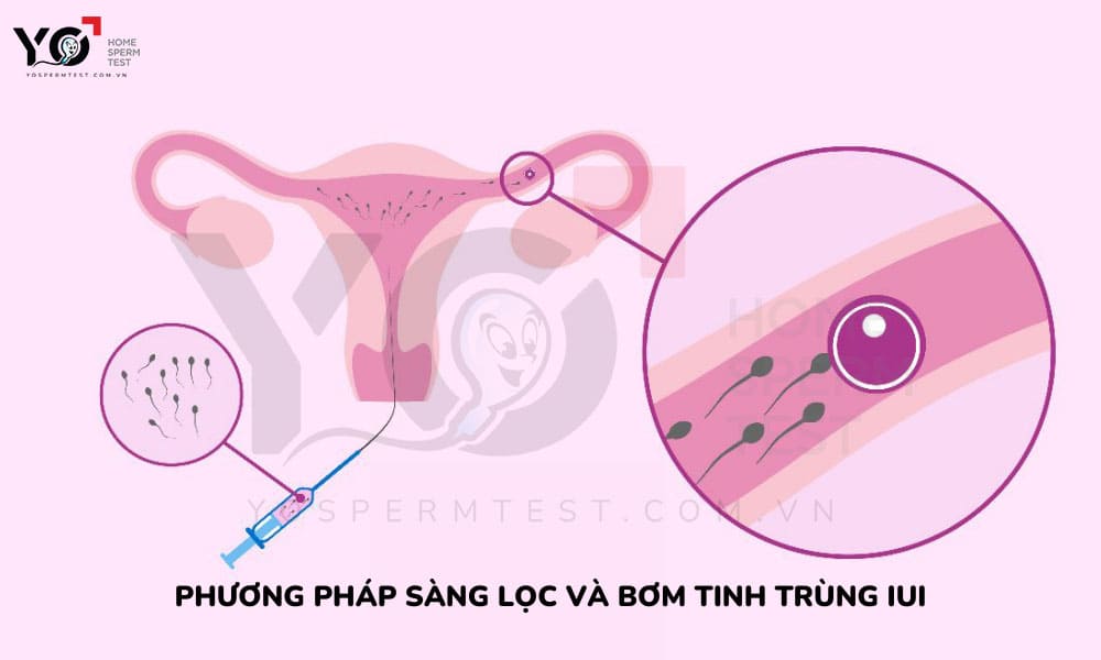 Phương pháp bơm tinh trùng IUI
