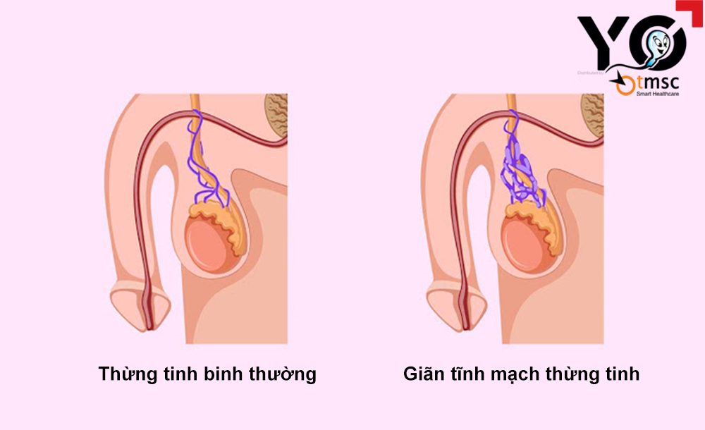 gian tinh mach tinh hoan o nam gioi
