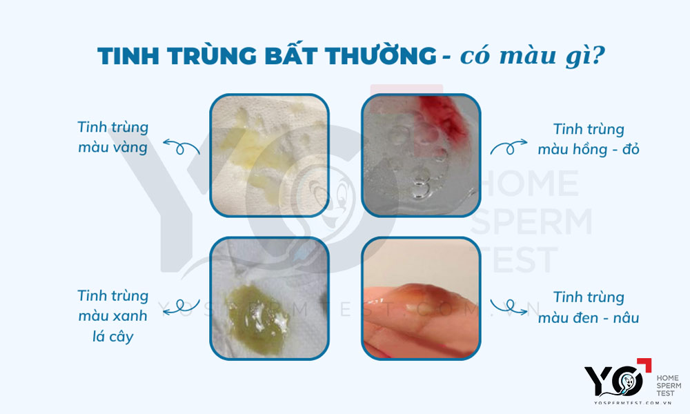 Tinh trùng bất thường sẽ có những màu khác biệt