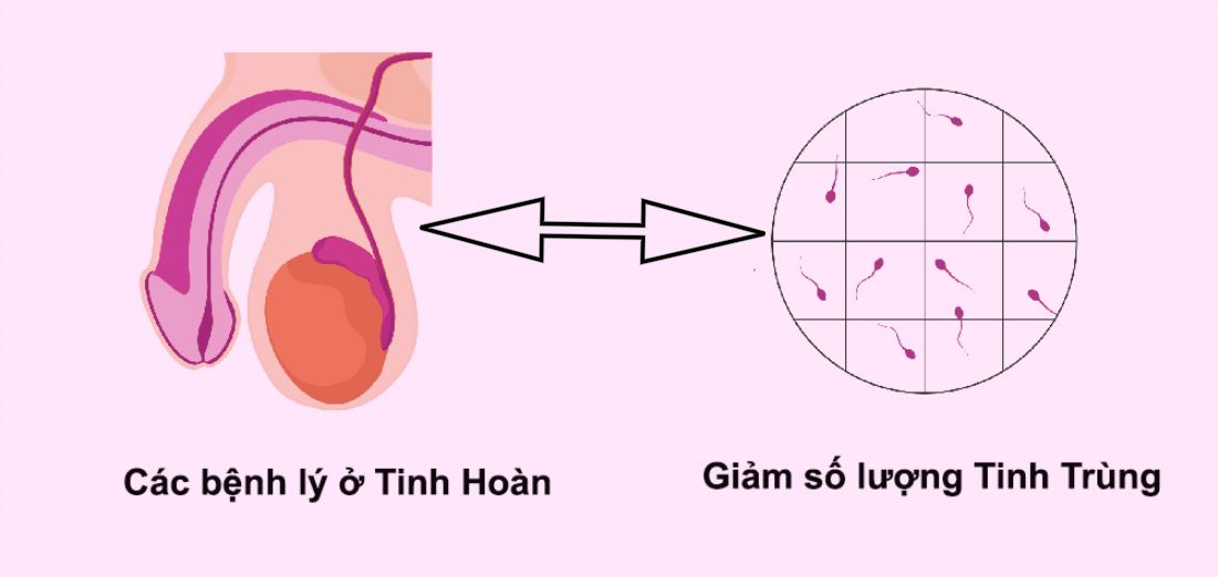 Vấn đề ở tinh hoàn gây tinh trùng vón cục