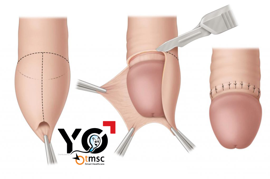 Thủ thuật cắt bao quy đầu cũng có thể khiến tinh dịch có mùi khác lạ