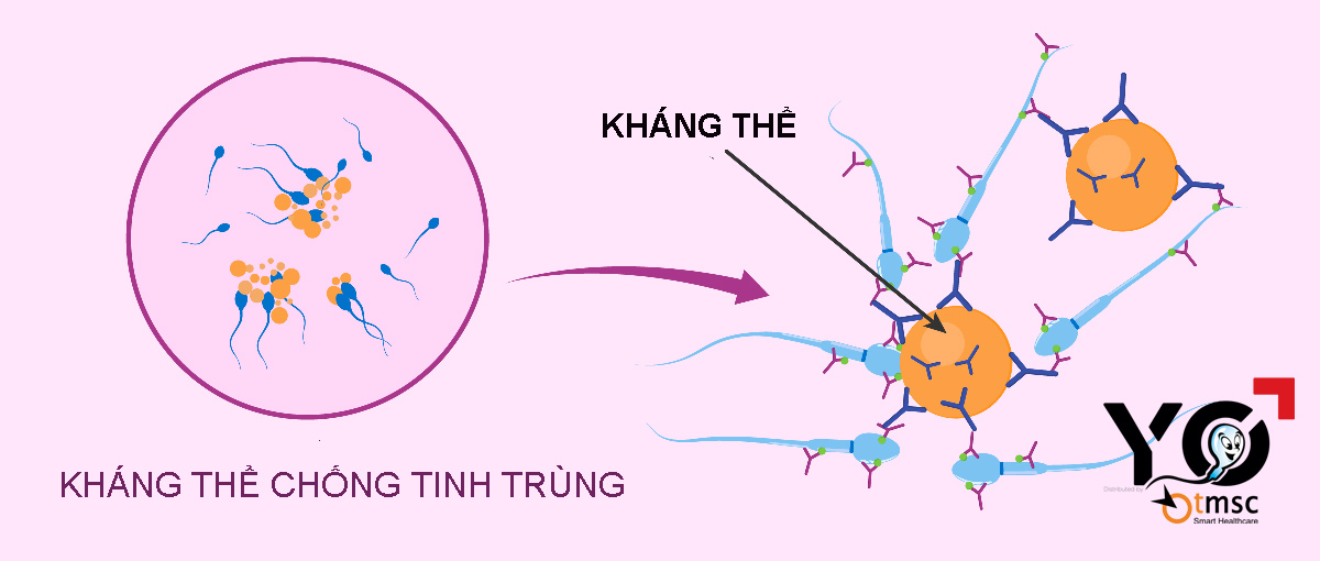 Bị kháng thể tiêu diệt nhầm khiến số lượng tinh trùng ít