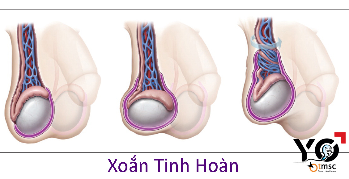 Tinh hoàn nằm ngang sau đó dẫn tới Xoắn Tinh Hoàn
