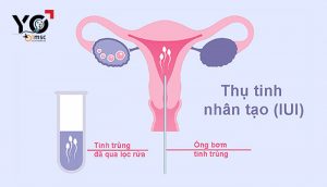Bom tinh trung IUI