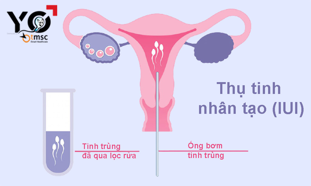 bom-tinh-trung-iui-la-gi