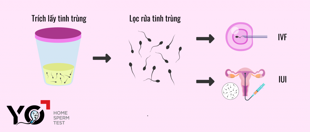 Chữa hiếm muộn cho người xuất tinh ngược thể nặng