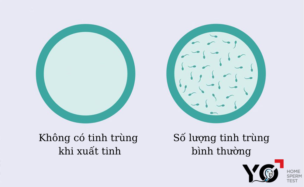 Không có tinh trùng khi xuất tinh