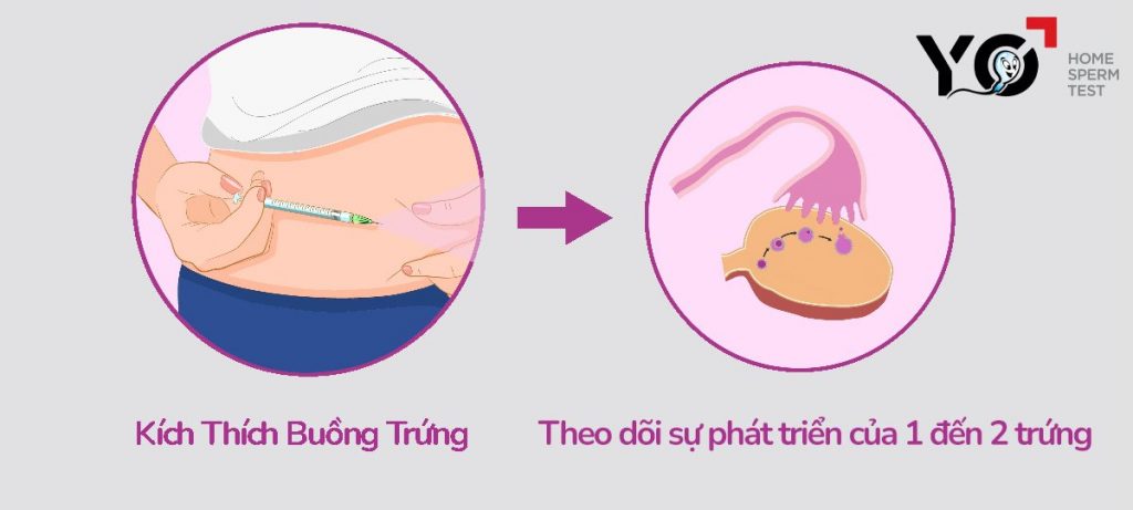 Kích thích buồng trứng để theo dõi