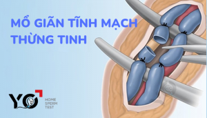 MỔ GIÃN TĨNH MẠCH THỪNG TINH