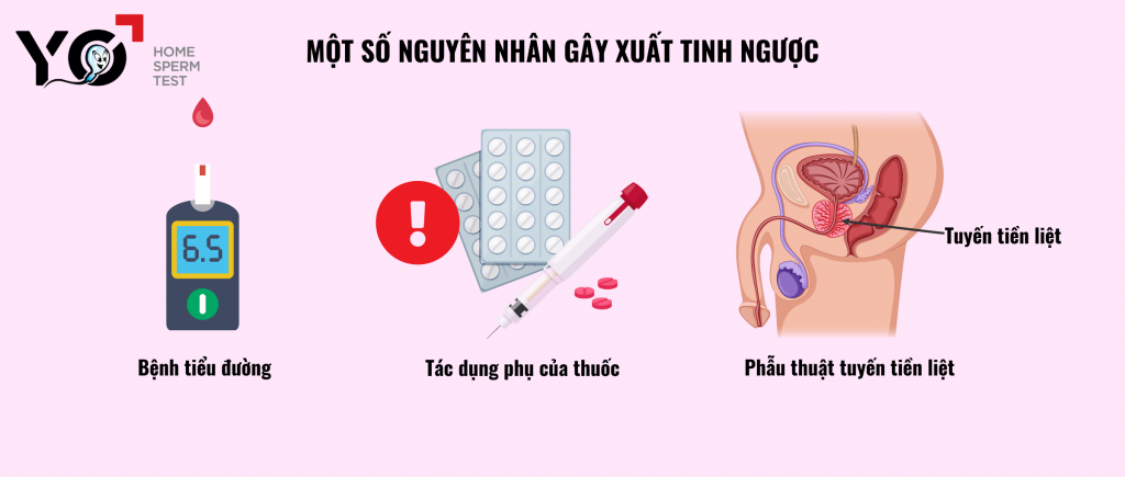 Một số nguyên nhân gây xuất tinh ngược ở nam giới