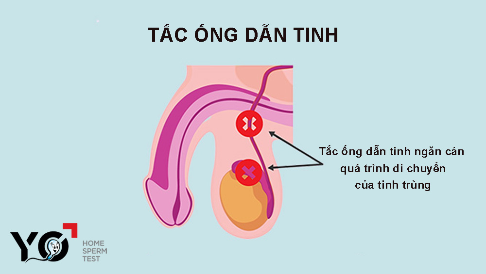 Tắc ống dẫn tinh
