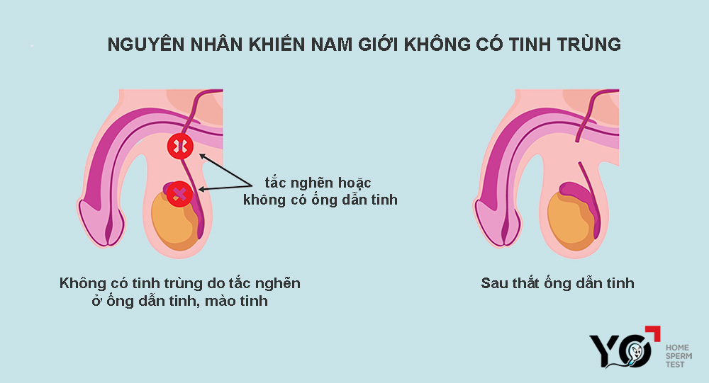 Một số nguyên nhân dẫn tới không có tinh trùng