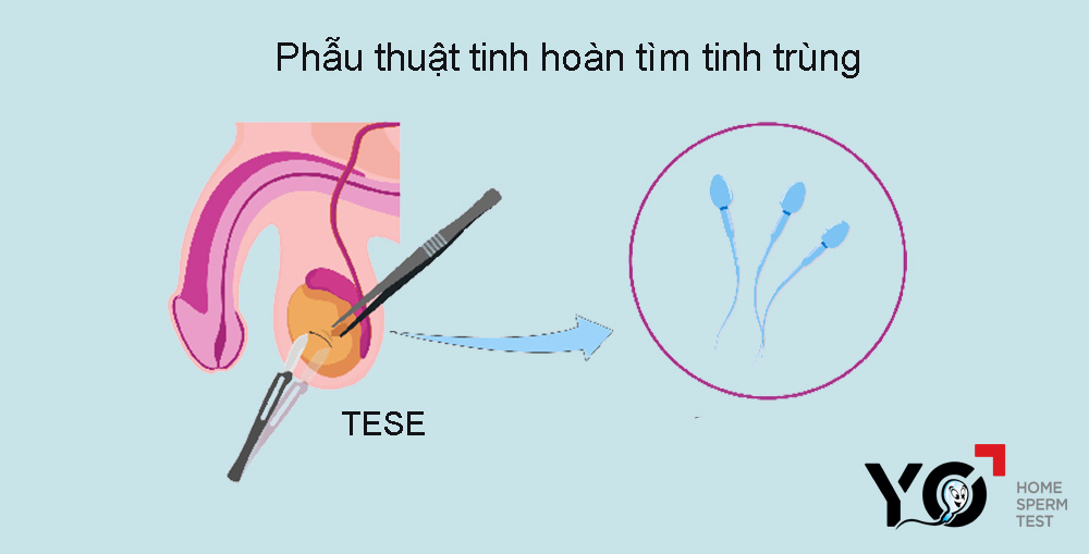 Phau thuat tinh hoan tim tinh trung