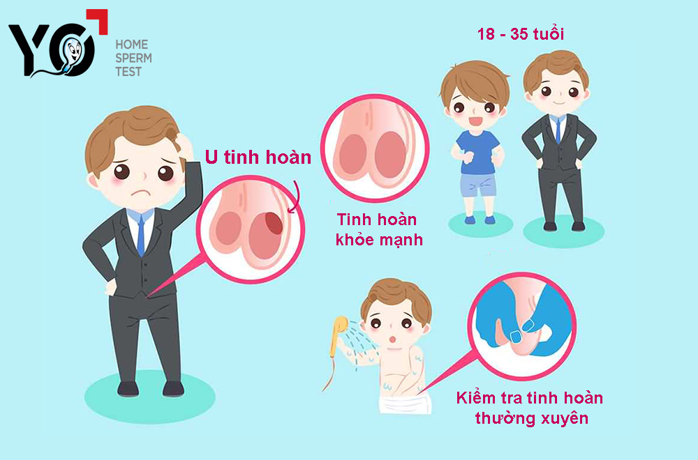 Siêu âm tinh hoàn là bước đầu hỗ trợ chẩn đoán ung thư tinh hoàn