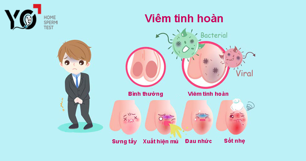 Siêu âm tinh hoàn phát hiện các ổ mủ, viêm nhiễm trong tinh hoàn