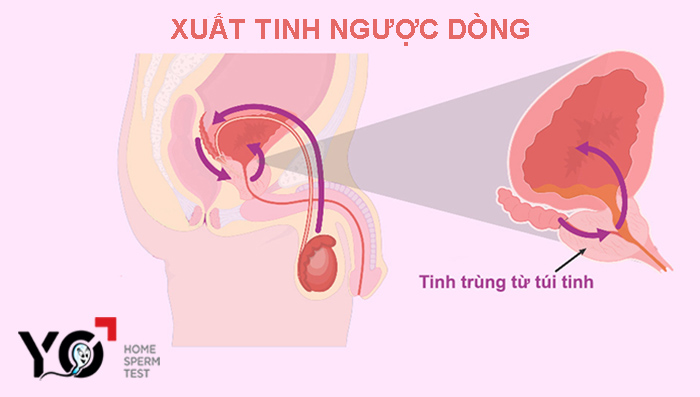 Xuất tinh ngược dòng