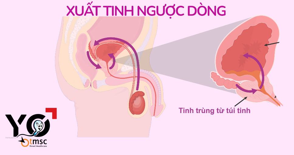 Xuất tinh ngược ở nam giới