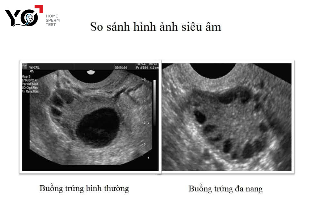 Buồng trứng đa nang là nguyên nhân gây vô sinh phổ biến ở phụ nữ
