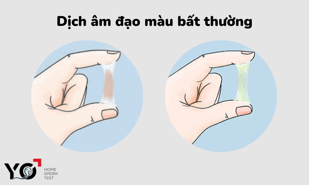Dịch âm đạo màu bất thường có thể là một triệu chứng vô sinh ở phụ nữ