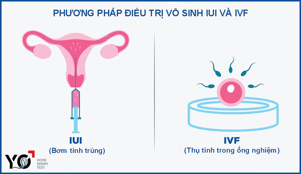 IUI và IVF là hai phương pháp điều trị vô sinh cho tỷ lệ thành công cao