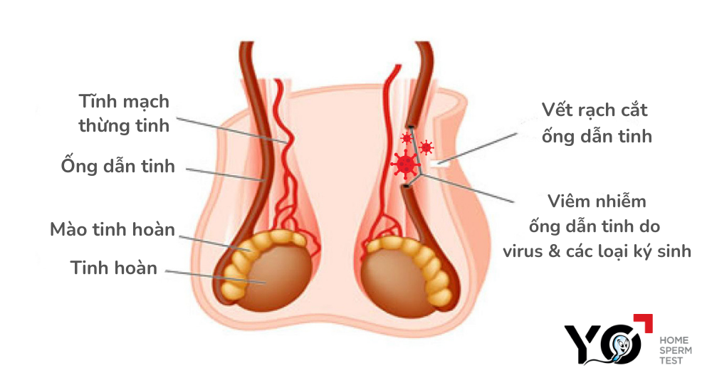 Viêm ống dẫn tinh