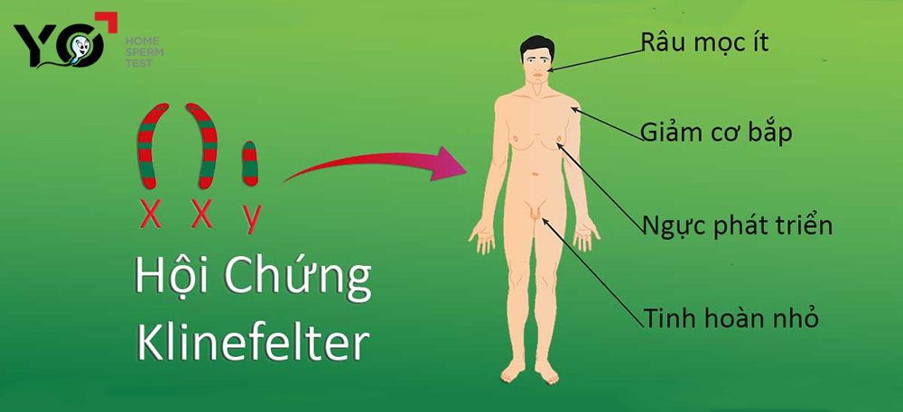 Hội chứng Klinefelter gây vô sinh ở nam giới