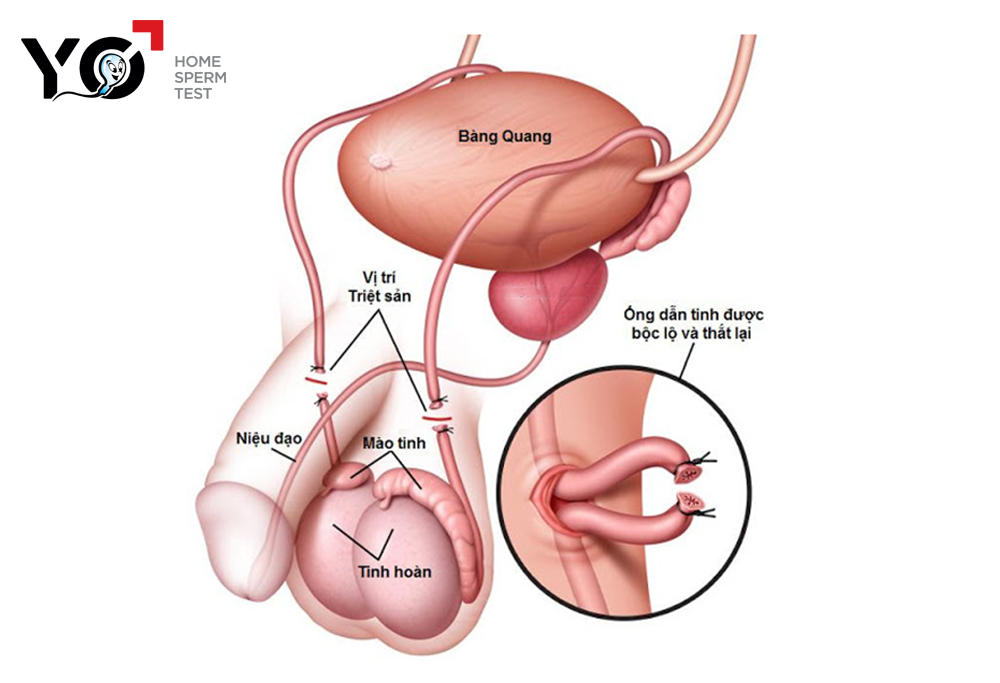 Phẫu thuật thắt ống dẫn tinh để thực hiện kế hoạch hóa gia đình