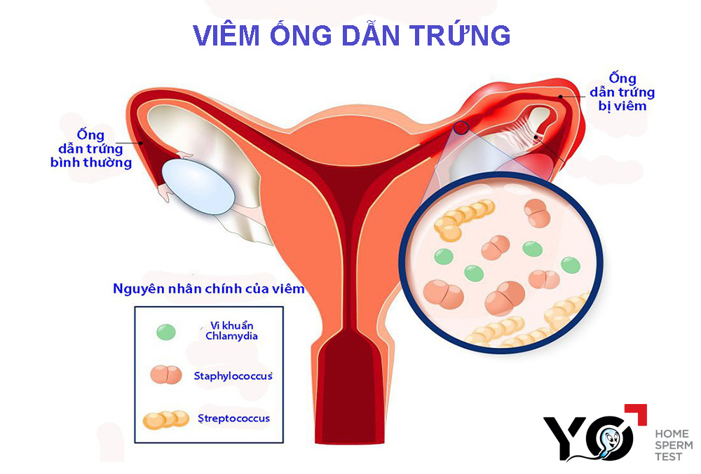 Viêm ống dẫn trứng gây tắc nghẽn ống dẫn trứng ngăn cản trứng rụng gặp tinh trùng