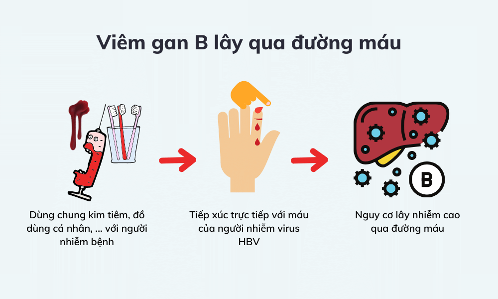 Bệnh viêm gan B lây truyền trực tiếp qua đường máu