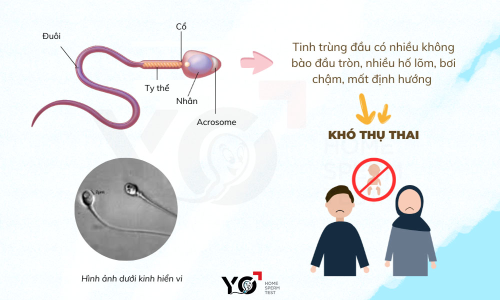 Khả năng thụ thai của nam giới bị ảnh hưởng khi tinh trùng đầu chứa nhiều không bào