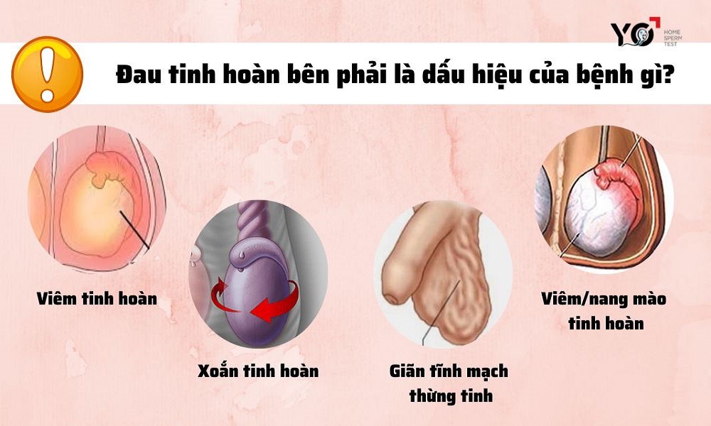 Đau tinh hoàn bên phải là dấu hiệu của một số bệnh lý nguy hiểm