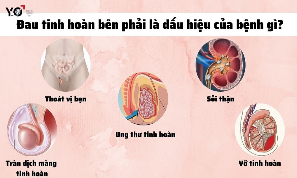 Một số bệnh lý nguy hiểm khi tinh hoàn bên phải bị đau