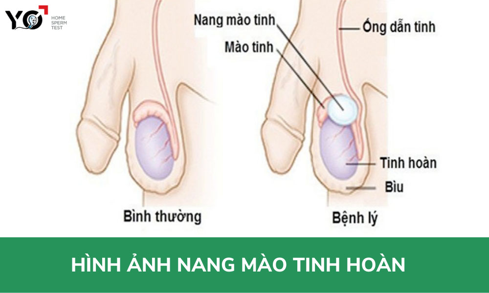 Nang mào tinh hoàn là bệnh gì?