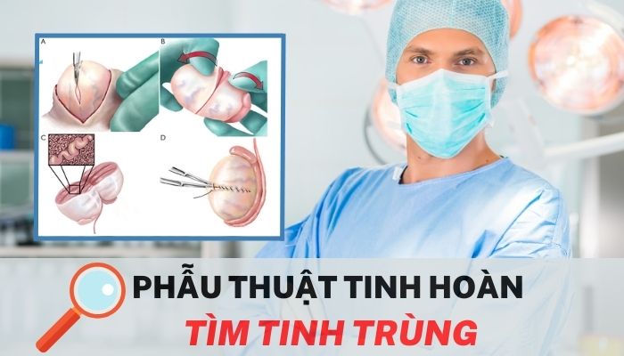 Phẫu thuật tinh hoàn tìm tinh trùng