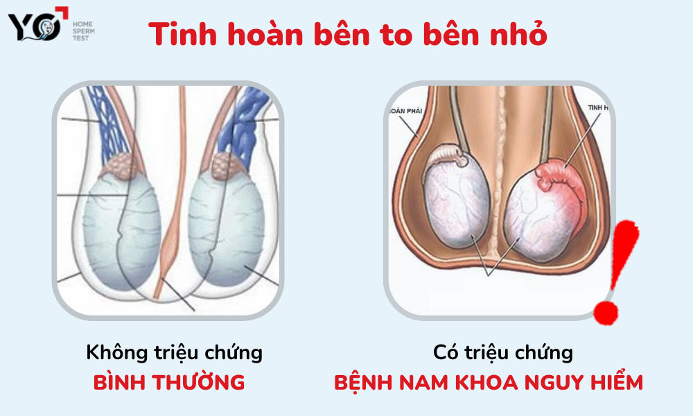 Tinh hoàn bên to bên nhỏ có sao không
