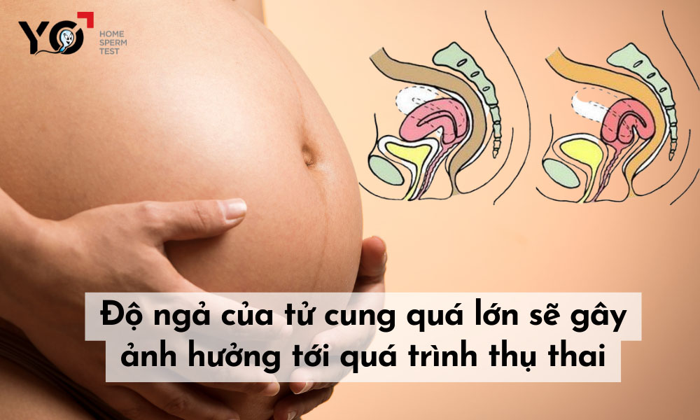 Tử cung quá ngả trước hoặc quá ngả sau gây cản trở quá trình thụ thai