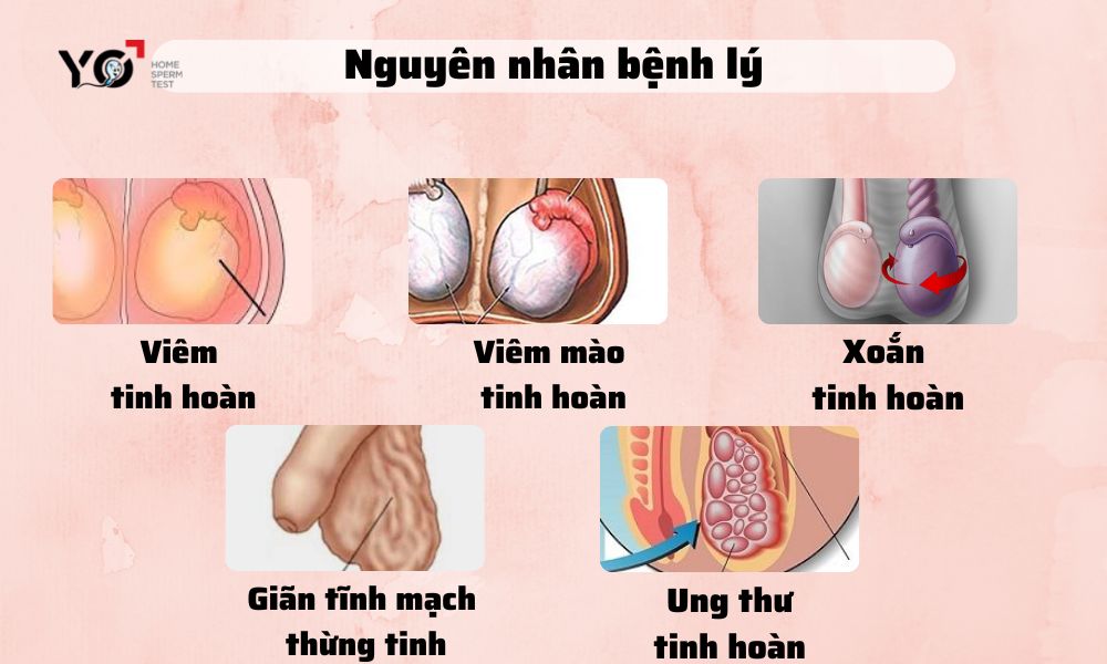 Nguyên nhân bệnh lý của hiện tượng đau tức tinh hoàn nhưng không sưng