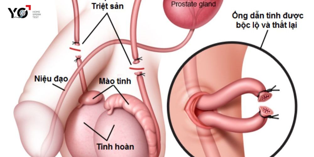 Mô tả phương pháp thắt ống dẫn tinh