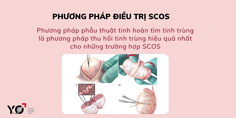 Phuong phap dieu tri hoi chung chi co 1 lop te bao sertoli