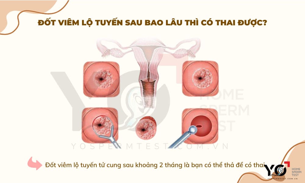 Sau 1 tháng đốt viêm lộ tuyến có thể mang thai