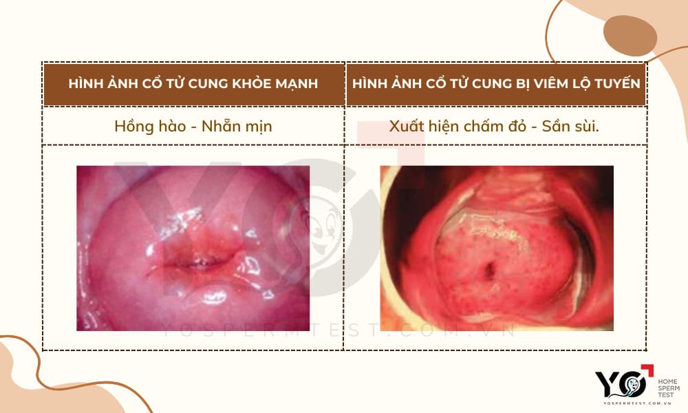 Viêm lộ tuyến cổ tử cung