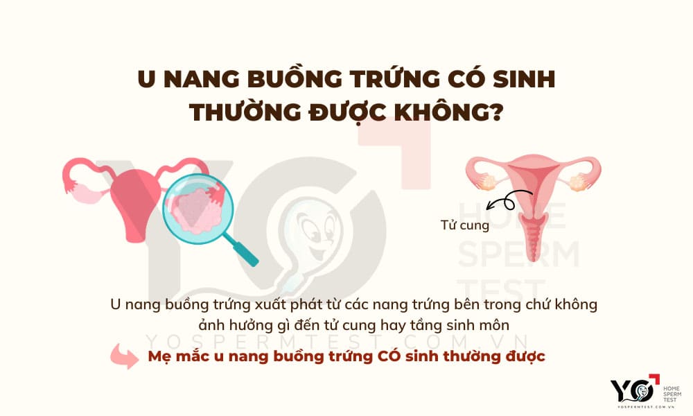 Mẹ có thể sinh thường được nếu từng mắc u nang buồng trứng